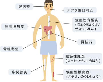 図2:クローン病の腸管外合併症