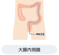 クローン病の検査：大腸内視鏡