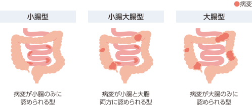 病変の範囲による分類(小腸型(病変が小腸のみに認められる型)・小腸大腸型(病変が小腸と大腸両方に認められる型)・大腸型(病変が大腸のみに認められる型)